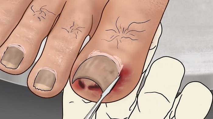 修脚足疔模拟器汉化版v1.0截图1